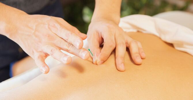 Dry Needling